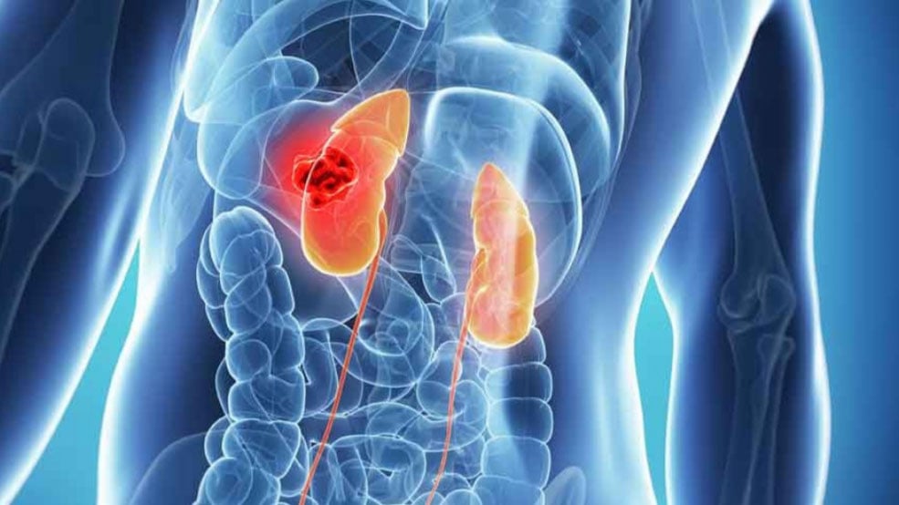 Chronic Kidney Disease Monthly Classes