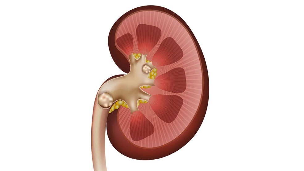 Kidney Stones Symptoms and Treatment