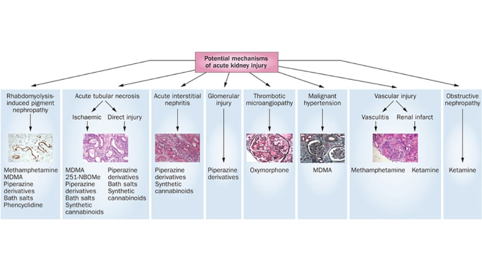 Synthetic Weed, Kidney Injury. Dr. Eftekhari article published