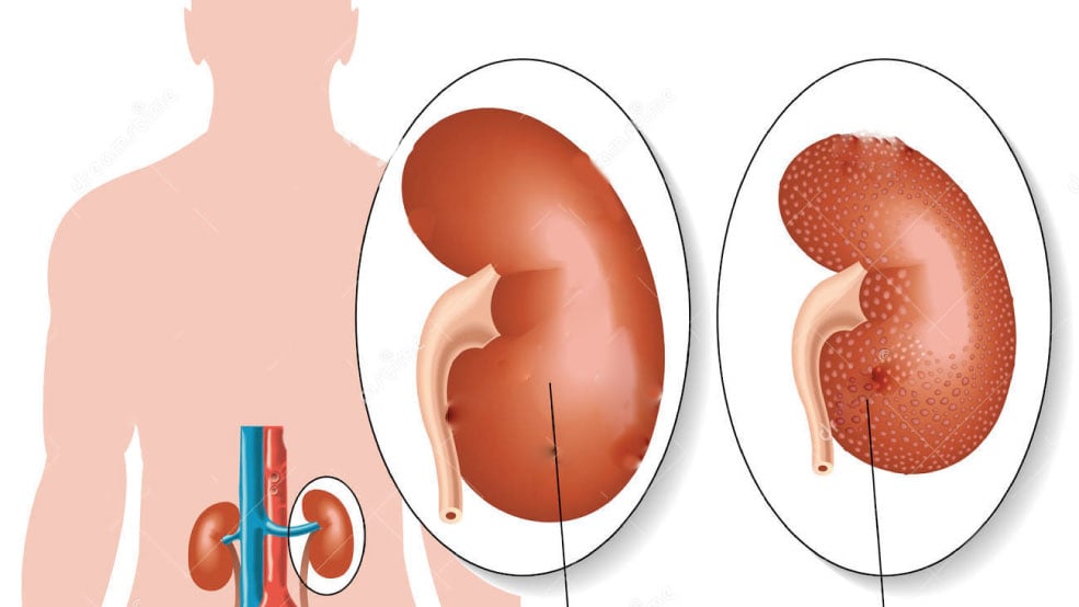 Diabetes, Depression and Kidney Disease