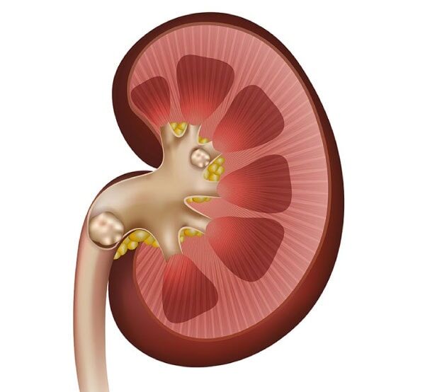 kidney with kidney stones