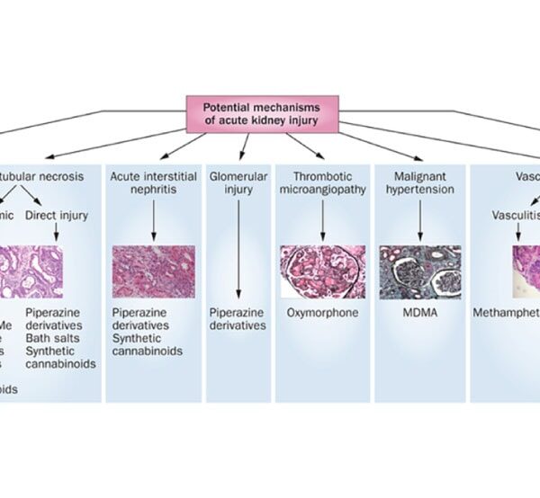 Acute Kidney Injury AKI
